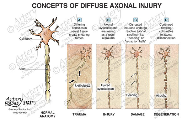 diffuse axonal injury mechanism